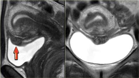 The Radiology Assistant : Endometriosis - MRI detection