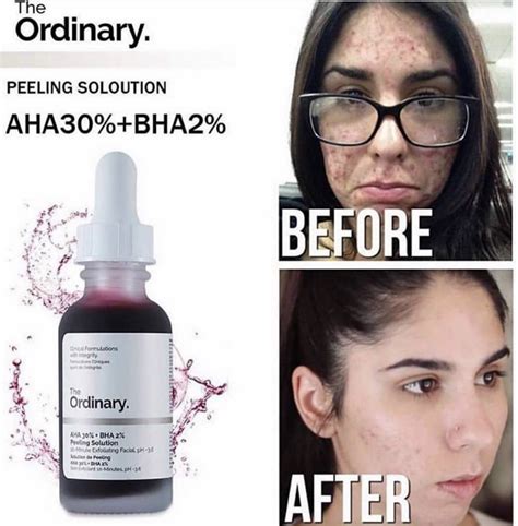 The Ordinary AHA 30% BHA 2% Peeling Solution | Facial skin care routine, Best acne products ...