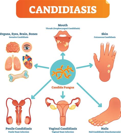 Diabetes and Yeast Infections: How Can Diabetic Patients Get Rid of Yeast Infections?