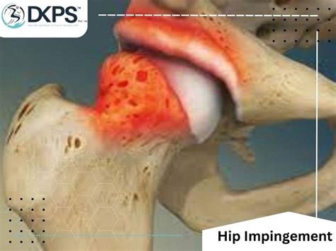 Hip Impingement - Drsinghphysiocare