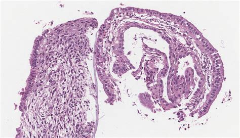 Proliferative Endometrium Mypathologyreport Ca - vrogue.co