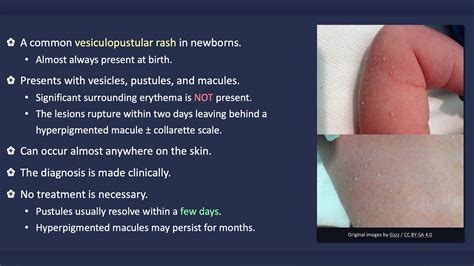 Transient Neonatal Pustular Melanosis - YouTube