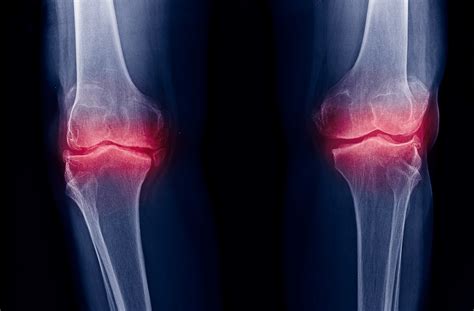 Radiographic Changes of Osteoarthritis Associated With Persistent Knee Pain - Rheumatology Advisor
