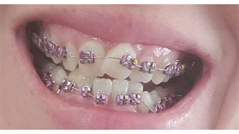 braces time lapse - YouTube