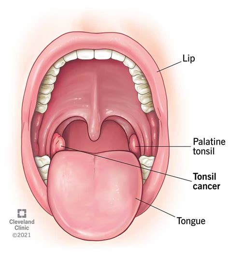 Tonsil Cancer: Symptoms, Signs & Causes