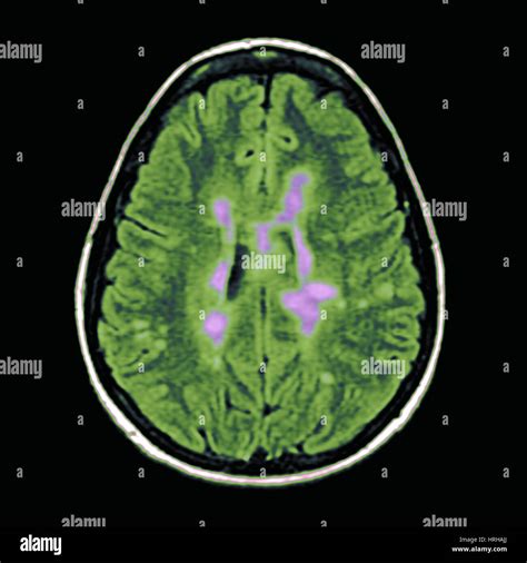 MRI of Multiple Sclerosis Stock Photo - Alamy