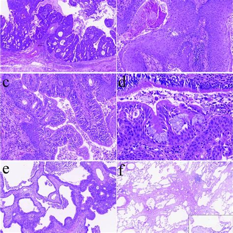 The histological evaluation of the tumor shows papillary structures of ...