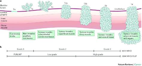 Bladder cancer WHO 1973 and 2004 staging of urothelial tumors (24) a)... | Download Scientific ...