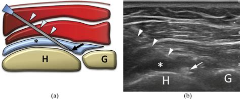 (a) Scheme and (b) ultrasound image of glenohumeral intra-articular... | Download Scientific Diagram