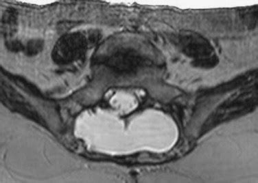 Incidental durotomy during spine surgery: Incidence, management and complications. A ...