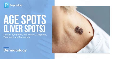 Age Spots (Liver Spots): Causes, Symptoms, Risk Factors, Diagnosis, Treatment and Prevention