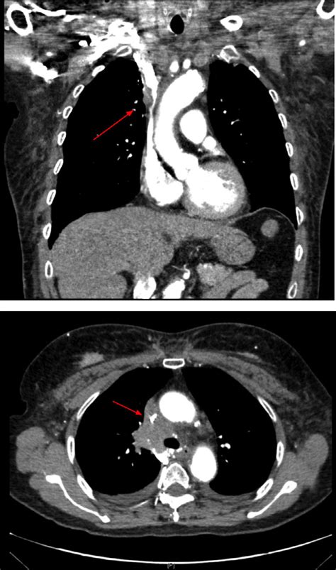 -CT-coronal view and axial views demonstrating SVC compression by the... | Download Scientific ...