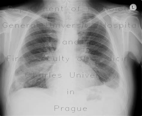 Radiology case: Pulmonary embolism, CT angiogram sign, pulmonary infarction