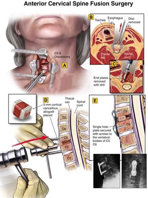 acdf surgery - Google Search | Neck surgery, Acdf surgery, Spinal surgery