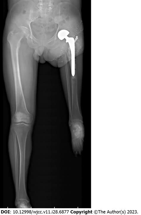 Rotationplasty type BIIIb as an effective alternative to limb salvage procedure in adults: Two ...