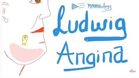 LUDWIG ANGINA: Causes, Clinical Picture, Diagnosis and Management - Odonto-Tv