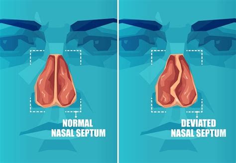 Deviasi Septum Nasal - patofisiologi, diagnosis, penatalaksanaan ...