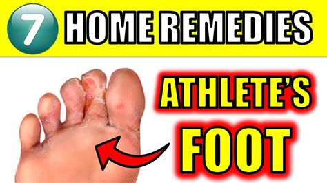 Athlete’s Foot : 7 Amazing Home Remedies To Beat This Fungal Infection ...