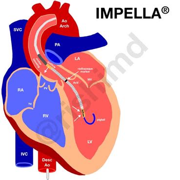 High risk PCI with Impella Device | Perioperative Talk