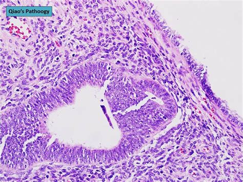 Qiao's Pathology: Mixed Endometrial-Endocervical type of Cervical Polyp ...