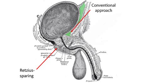 Retzius-sparing radical prostatectomy: one year on - Santis | Private ...