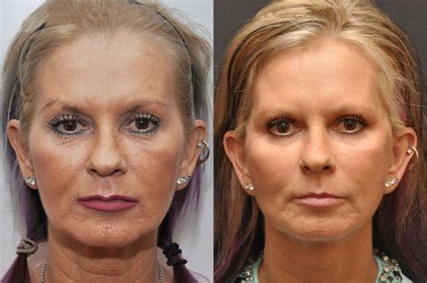 Facial Liposuction Photos - Cincinnati Facial Plastic Surgery