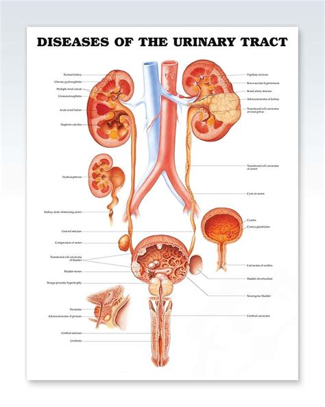 Diseases of the Urinary Tract Exam Room Anatomy Poster – ClinicalPosters