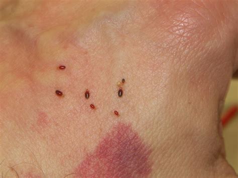 Treatments for Bedbug Bites Itching and Inflammation