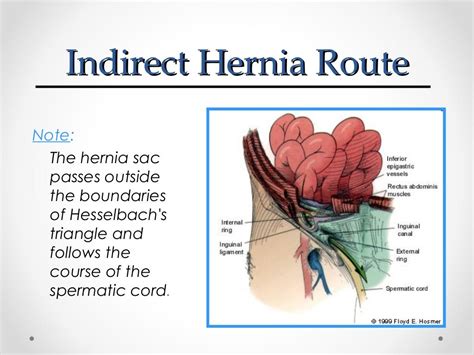 Inguinal Hernia Types Causes Symptoms Treatment Preve - vrogue.co