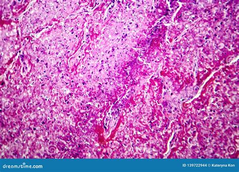 Caseation of Human Tuberculosis Granuloma, Light Micrograph Stock Photo ...