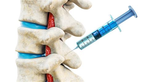 Facet Joint Injections: Everything You Need to Know - Spine Info