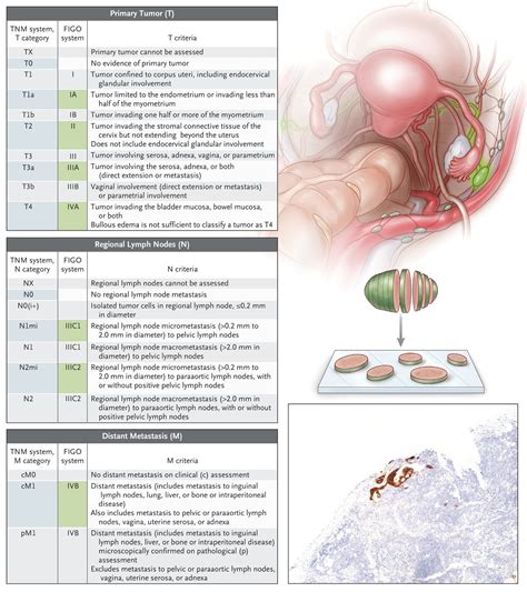 Endometrial Adenocarcinoma Grade 1