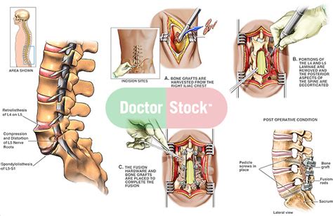 Back Surgery - L5-S1 Spondylolisthesis with Surgical Repair | Doctor Stock