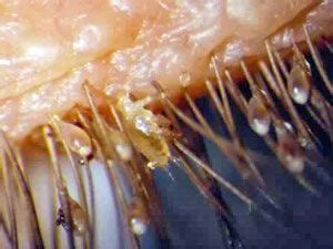How to Get Rid of Mites on Humans: Types of Mites on Humans and ...