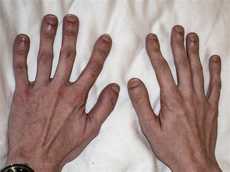Clubbed fingers: Causes, symptoms, treatment, and when to seek help