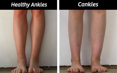 Causes & How To Get Rid of Cankles with Exercise & Surgery