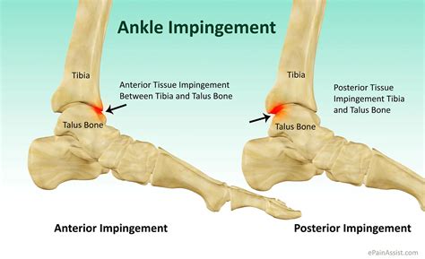 What is Ankle Impingement|Symptoms|Causes|Treatment|Recovery Period ...