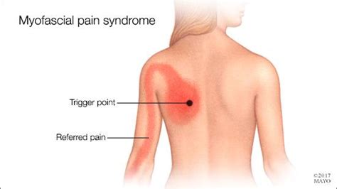 Myofascial Pain Syndrome (Muscle Pain) | SSOC