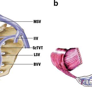 Diagram of the (a) presacral venous plexus and the (b) bleeding site ...