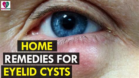Home Remedies for Eyelid Cysts - Health Sutra - YouTube