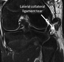 Fibular Collateral Ligament Mri