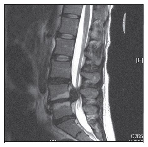 Cauda equina syndrome from lumbar disc herniation | CMAJ