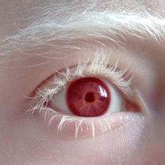 Oculocutaneous Albinism Eyes