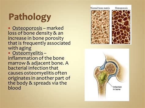 What is normal bone density range: Bone Density Test, Osteoporosis Screening & T-score ...