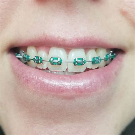 best teal braces – Braces Explained