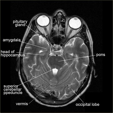 Ct Scan Brain Anatomy : Anatomy Of Head Ct Scan Normal The Brain On Ct And Mri ... / Frontal ...