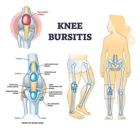 What Is Knee Bursitis and SHould I Be Worried?