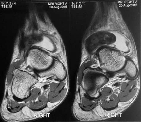 PVNS of the Ankle | Sudden Acute Ankle Pain | HC Chang Orthopaedic Surgery | Singapore