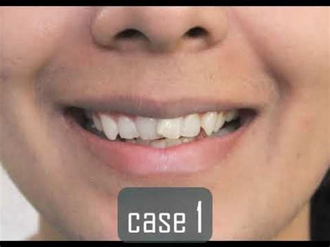 Overlapping teeth ? Smile makeover by Dr Trivikram | - YouTube