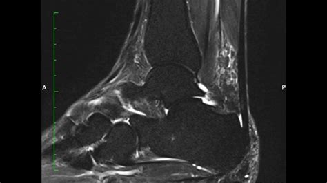 MRI ankle Split Peroneus Brevis Tear - YouTube